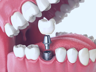 How Much Do Dental Implants Cost? | Ballantyne Dental Blog